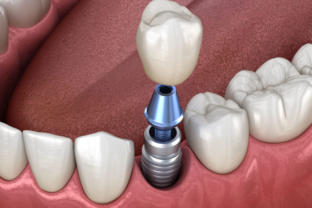 dental implant model Cedarhurst, NY