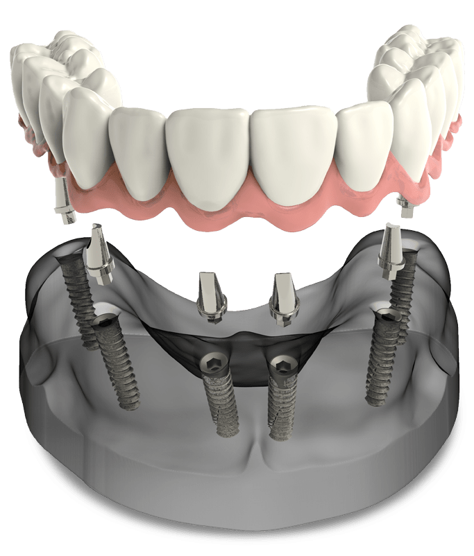 full arch dental implants model Cedarhurst, NY