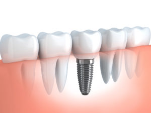 Dental implant complications Cedarhurst, NY.