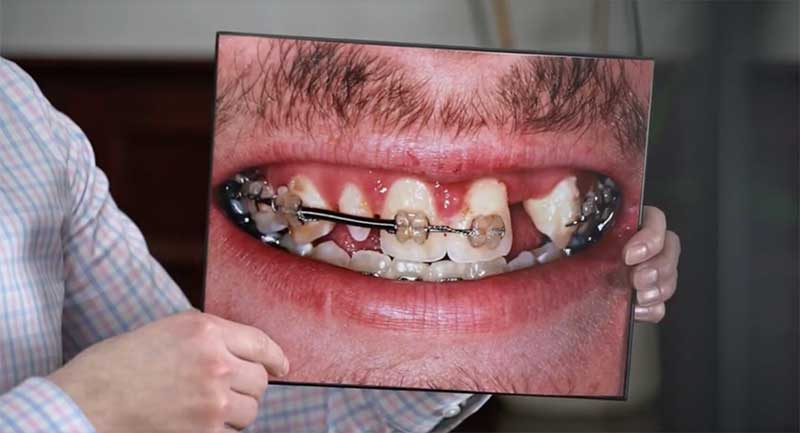 full mouth reconstruction before Cedarhurst, NY