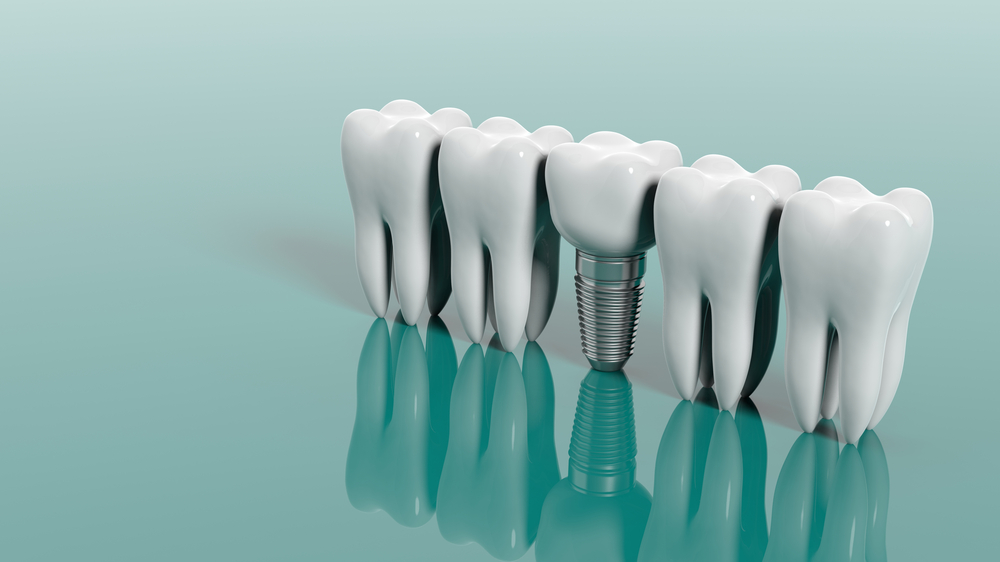 Why You Should Lean Toward Dental Implants
