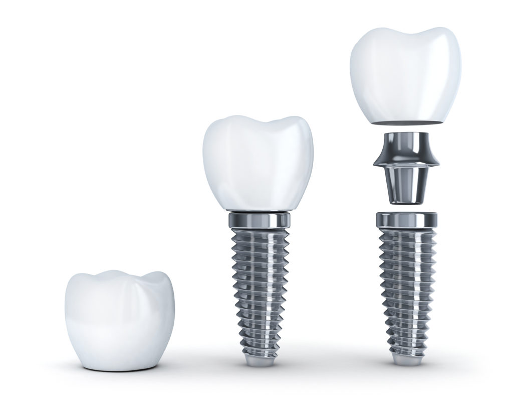 Questions About Dental Implants