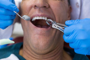 Tooth Extraction Process
