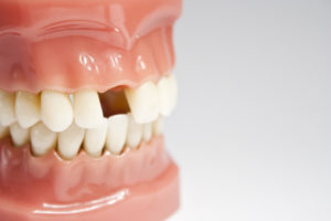 The Dangers of Missing Teeth