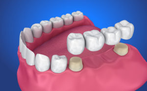 Traditional Dental Crowns