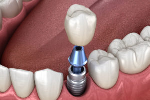 Dental Implant Graphic