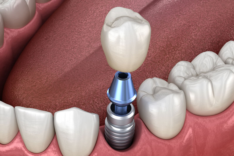 Dental Implant Graphic