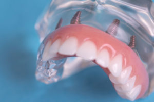 Dental Implants
