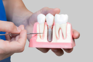 Dental Assistant Showing Off A Dental Implant In A Jawbone Cutaway Model in Cedarhurst, NY