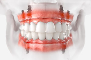 a digital representation of full mouth dental implants placed in a jaw.