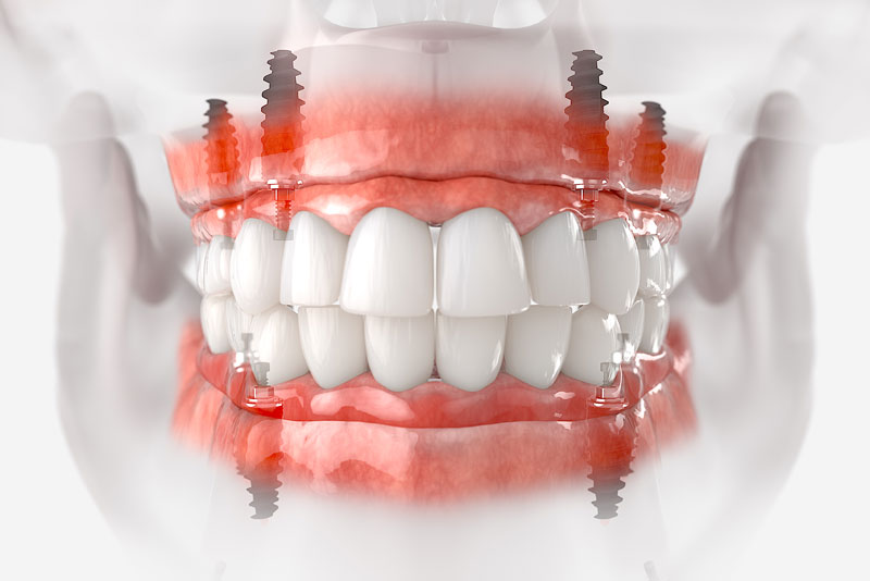 a digital representation of full mouth dental implants placed in a jaw.