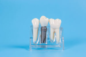 an image of a single dental implant model surrounded by a single tooth model on either side of it in a display holder.