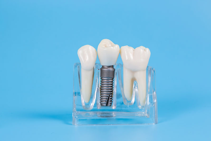 an image of a single dental implant model surrounded by a single tooth model on either side of it in a display holder.