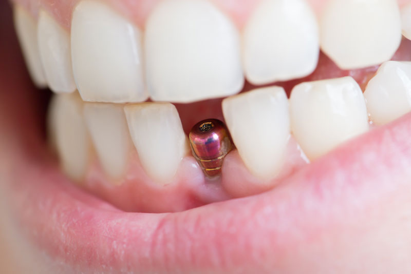 a picture of a patients smile showing where her extracted tooth in her lower arch has been replaced by a dental implant post for her dental implant procedure.
