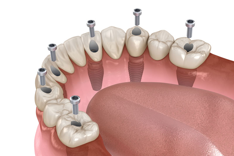 a picture of a full mouth dental implant model for a Teeth-In-A-Day procedure. the dental implant posts are shown where the temporary prosthesis is being secured to the patients jawbone.