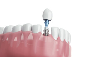a digital model of a single dental implant being placed into a lower arch.
