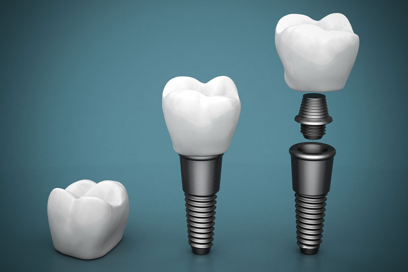 how the three parts of a dental implant are put together. the tooth crown is placed on the abutment, which attaches to the dental implant post.