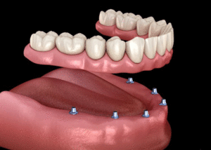 an image of a dental implant.