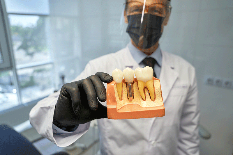 Doctor holding a model of a dental implant