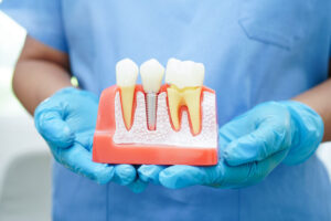 Doctor hold dental implant, artificial tooth roots into jaw, root canal of dental treatment, gum disease, teeth model for dentist studying about dentistry.