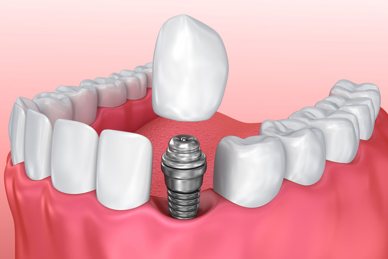 3D illustration of a dental implant placement showing the titanium post and crown. Highlights the structure and process of tooth replacement with implants.