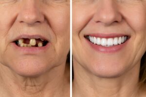 Image depicting a before-and-after transformation of a patient receiving "teeth in a day" treatment. The "before" side shows missing or damaged teeth, and the "after" side shows a complete, natural-looking set of teeth. No text on the image.