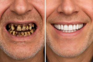 Before and after photo of a patient who had full mouth reconstruction with dental implants, showcasing a severely damaged set of teeth next to a perfect smile. No text on the image.